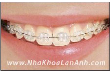 Các hệ thống mắc cài sử dụng trong chỉnh nha