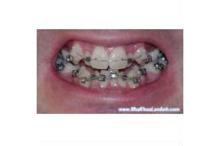 Chỉnh nha cho trường hợp răng mọc chen chúc