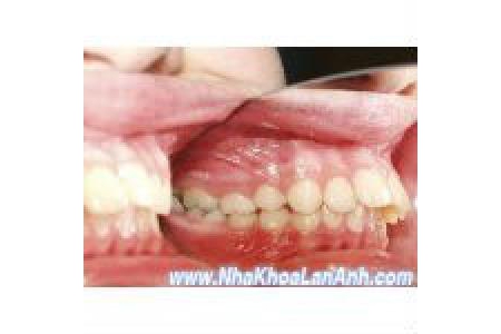 Chỉnh nha – Niềng răng cho trường hợp hô