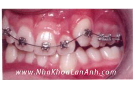 Diễn biến các giai đoạn của trường hợp chỉnh nha – niềng răng chen chúc
