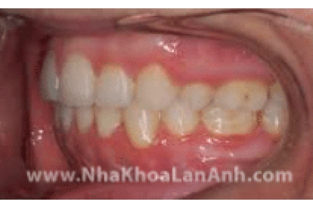 Một số câu hỏi thường gặp khi điều trị chỉnh nha