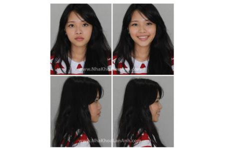 Một số hình ảnh tham khảo trước và sau khi điều trị chỉnh nha – Phần 2
