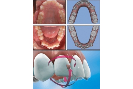 Đặc điểm và quy trình của chỉnh nha (niềng răng) bằng khay Invisalign