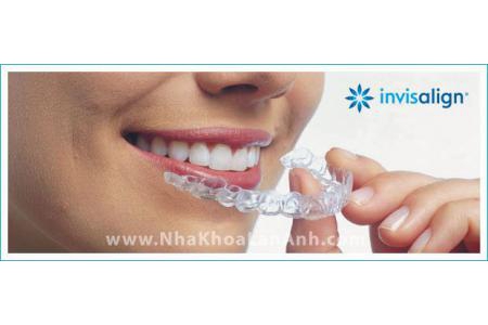 Những câu hỏi thường gặp về Invisalign (phần 2)