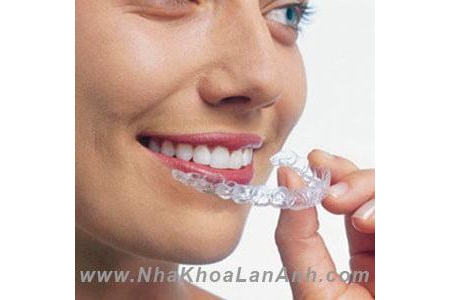 Những câu hỏi thường gặp về chỉnh nha bằng Invisalign (Phần 1)