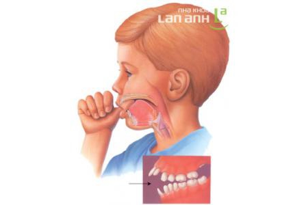Một số thói quen xấu có thể gây ảnh hưởng đến sức khỏe răng miệng