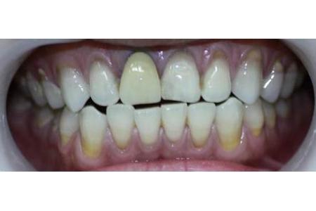 Khắc phục răng sứ bị đen viền nướu