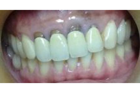 Răng sứ bị đổi màu và cách khắc phục