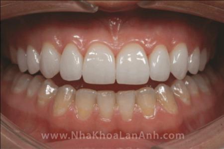 Màu sắc, thẩm mỹ của răng sứ Cerec như thế nào?