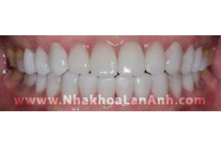 Răng em bị nhiễm thuốc kháng sinh tetracyline nặng thì có làm Veneer được không?