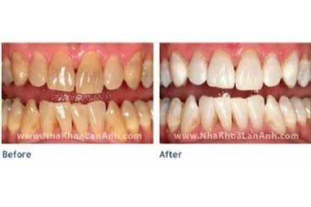 Răng sậm màu do kháng sinh, tẩy trắng răng bằng đèn Zoom có trắng được không?
