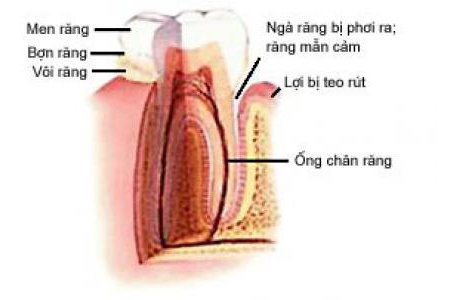 Răng Nhạy Cảm là gì?