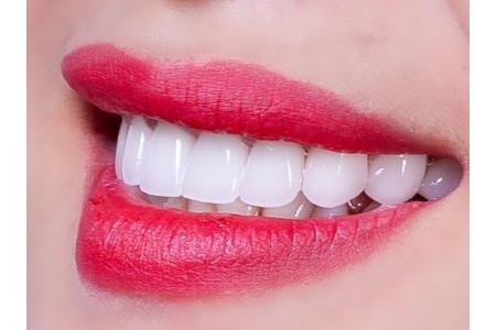 Để có chiếc răng sứ vừa trong, vừa sống động lại bền chắc theo thời gian