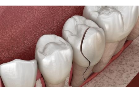 Bạn đã biết về tình trạng nứt, tét răng chưa?