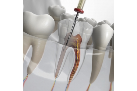 Vì sao răng chữa tủy thường hay thất bại và không giữ được lâu dài?