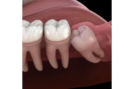 Răng khôn có ảnh hưởng như thế nào?