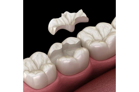Trám răng như thế nào để có độ bền lâu dài mà không nhạy cảm và ê buốt?