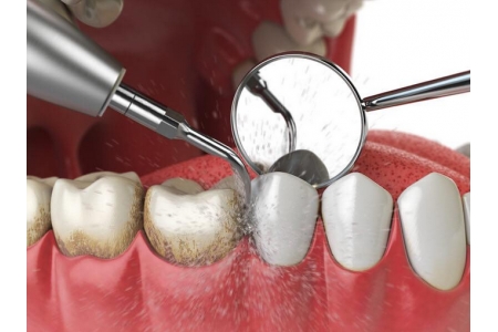 Cạo vôi răng có phải là kỹ thuật đơn giản