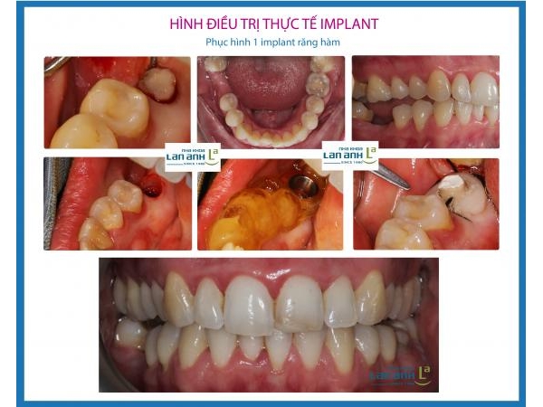 Cấy ghép Implant