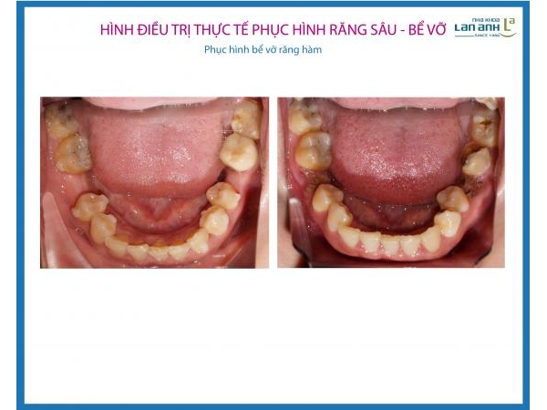 Phục hình răng sâu, bể, vỡ