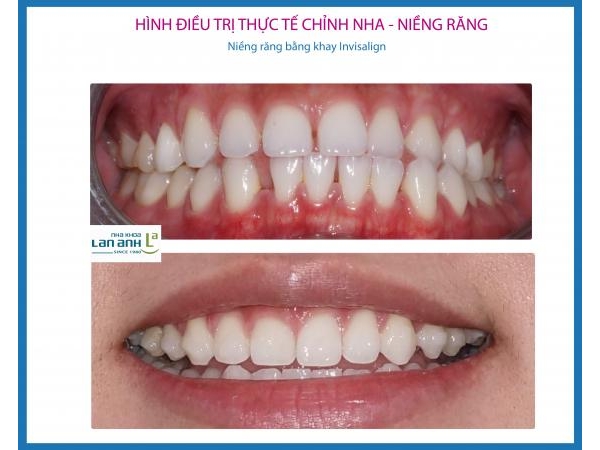 Chỉnh nha, niềng răng