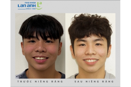 Bạn quan tâm đến điều gì khi niềng răng cho trẻ em?