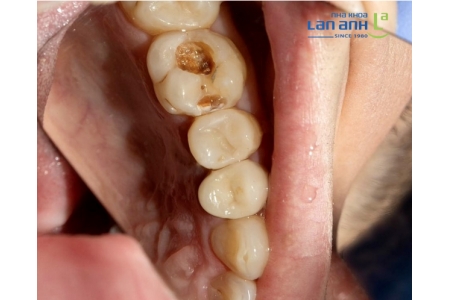 Sâu răng diễn ra như thế nào?