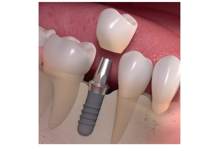 Thương hiệu của Implant có ảnh hưởng đến kết quả điều trị không?