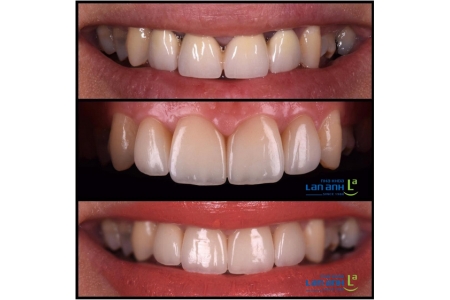 Tại sao sau khi làm răng sứ lại bị hôi miệng?