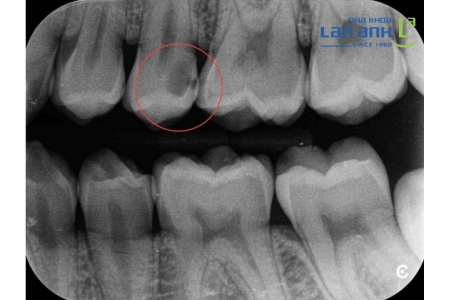 Sâu răng có dễ phát hiện được bằng mắt thường không?