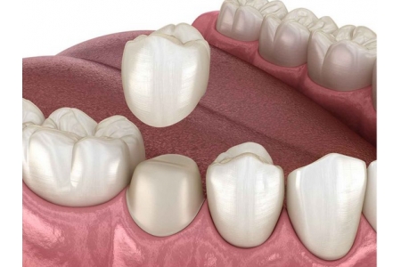 Răng sứ gắn lên đâu để có độ bền được lâu dài và vững chắc?