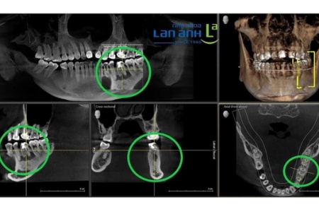 Đánh giá mức độ nhiễm trùng của răng như thế nào cho chính xác?