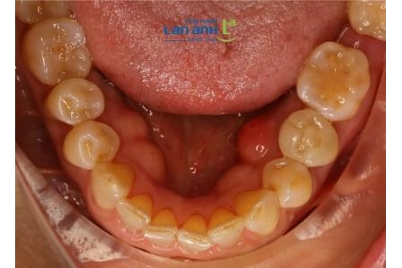 Làm sao để răng sứ khi làm không bị cộm?