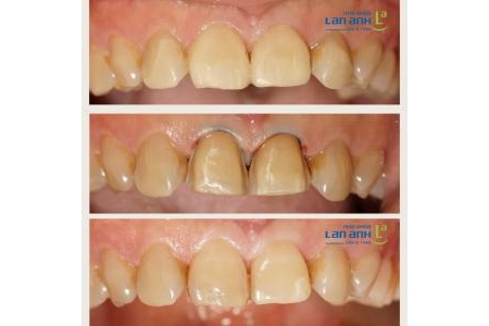 Một số trường hợp phục hình thẩm mỹ tại Nha Khoa Lan Anh