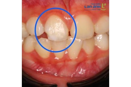 Trám răng thẩm mỹ cho trẻ em
