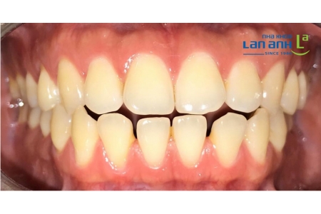 Một số trường hợp chỉnh nha bằng Invisalign