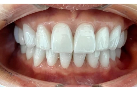 Răng sứ có độ bền bao lâu là hợp lý