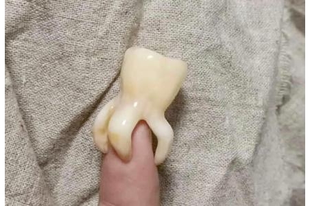 Độ khó của nhổ răng khôn phụ thuộc vào yếu tố nào?