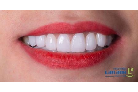 Răng sứ đẹp tự nhiên phải như thế nào?