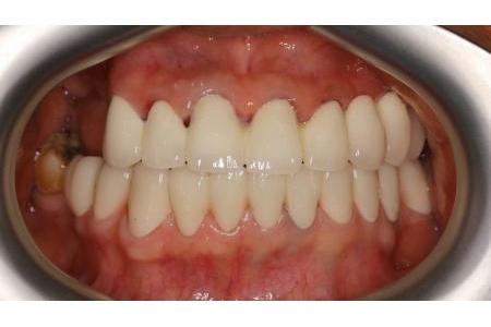 Một trường hợp phục hình răng sứ 2 hàm để ăn nhai và cải thiện thẩm mỹ
