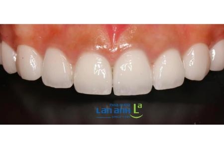 Góc nhìn cận cảnh răng sứ