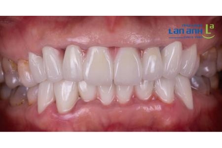 Răng sứ kim loại vì sao lại 