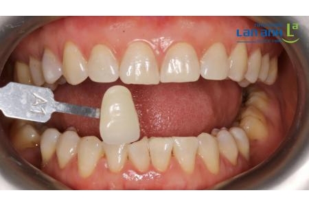 Răng trắng đẹp tự nhiên nhờ tẩy trắng