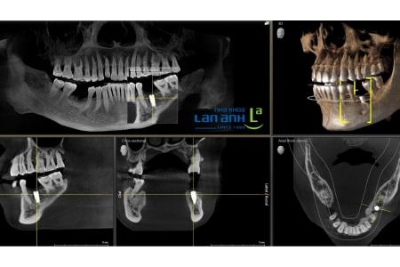 Độ bền của Implant phụ thuộc vào yếu tố nào?