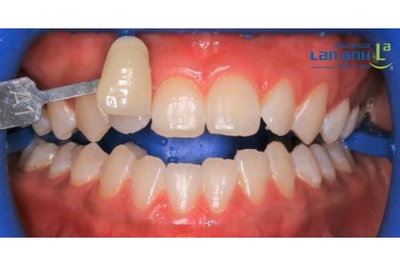 Nhẹ nhàng tẩy trắng răng chỉ sau 90 phút