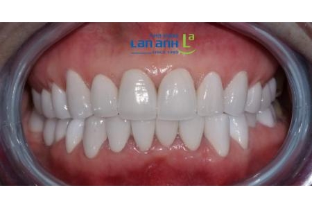 Đi thật xa rồi cũng quay trở về để làm răng sứ