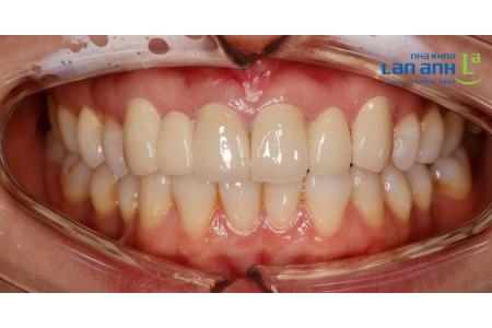 Răng sứ có đổi màu sau một thời gian dài sử dụng không?