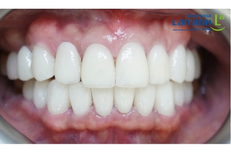 Làm răng sứ có bị đục hay nhìn 