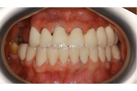 Một trường hợp phục hình răng sứ 2 hàm để ăn nhai và cải thiện thẩm mỹ