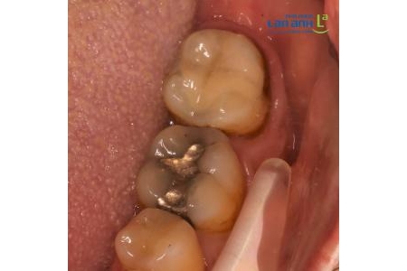 Phục hồi răng bằng Inlay sứ EMAX